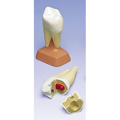 Molar superior dos raices , 2 piezas