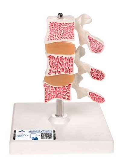 1000153 Modelo de Osteoporosis - versión de lujo (3 vertebrales) 