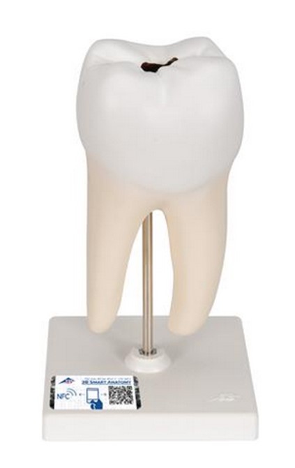 1000243 Molar inferior con 2 raíces 