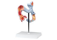 [6090.25] Enfermedades del colon. Modelo de 1/2 de su tamaño natural, muestra diversas patologías del colon y el apéndice.