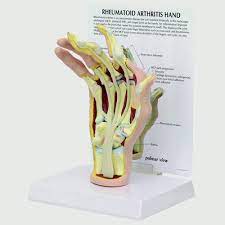 [W99999-828] Modelo de mano con artritis reumatoide